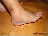 ...I accidentally badly sprained my ankle in a gym!